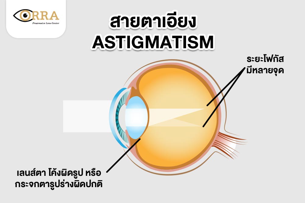 สายตาเอียง-Astigmatism